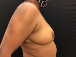 Breast Reduction