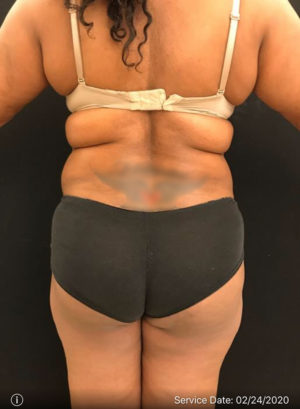 Liposuction