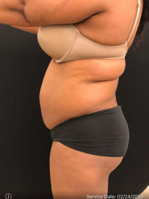 Liposuction