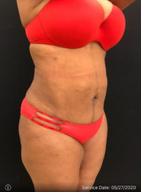 Liposuction