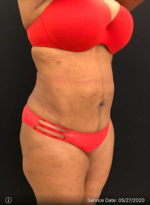 Liposuction