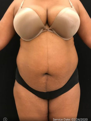 Liposuction