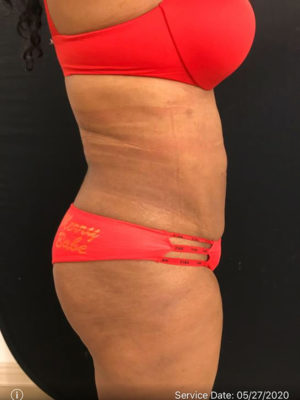 Liposuction