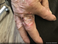 Squamous Cell Carcinoma