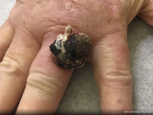 Squamous Cell Carcinoma