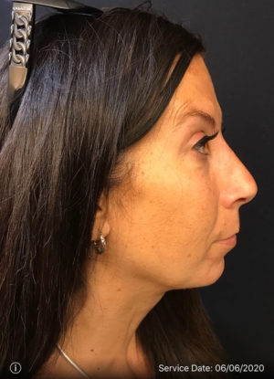 Rhinoplasty