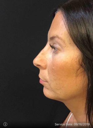 Rhinoplasty