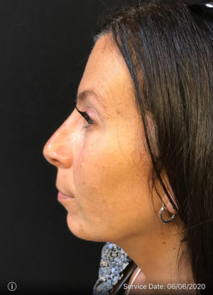 Rhinoplasty