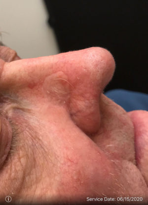 Basal Cell Carcinoma