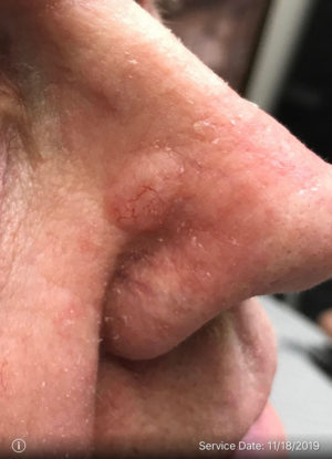 Basal Cell Carcinoma