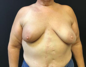 Breast Reconstruction