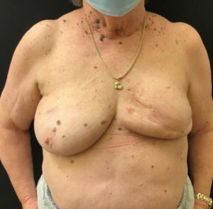 Breast Reconstruction