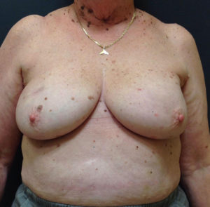 Breast Reconstruction