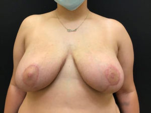 Breast Reduction