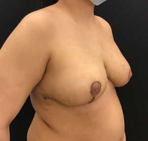 Breast Reduction