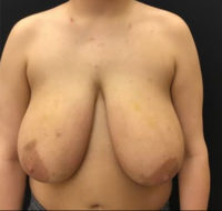 Breast Reduction