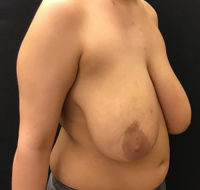 Breast Reduction