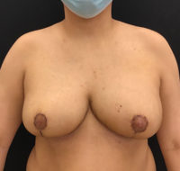 Breast Reduction
