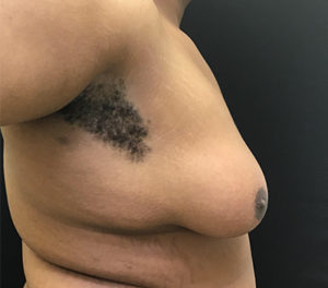 Gynecomastia