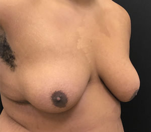 Gynecomastia