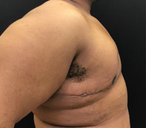 Gynecomastia