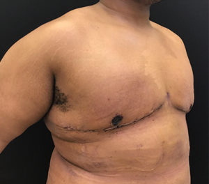 Gynecomastia