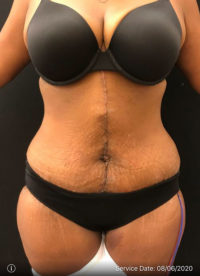 Tummy Tuck