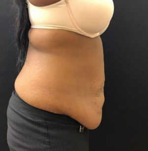 Tummy Tuck