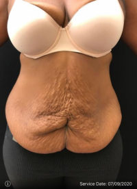 Tummy Tuck