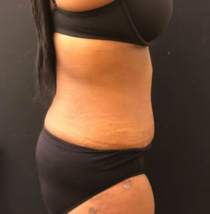 Tummy Tuck