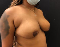 Breast Reduction
