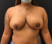 Breast Reduction