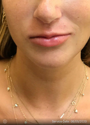 Lip Augmentation