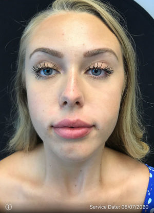 Lip Augmentation