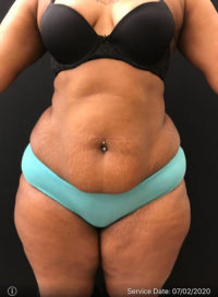 Liposuction