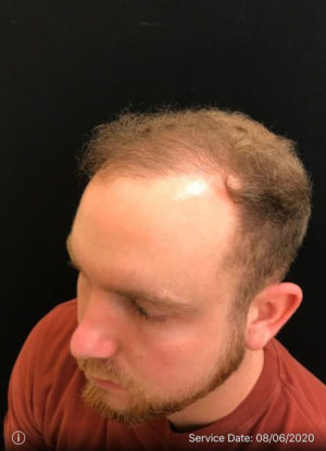 Neograft Hair transplantation