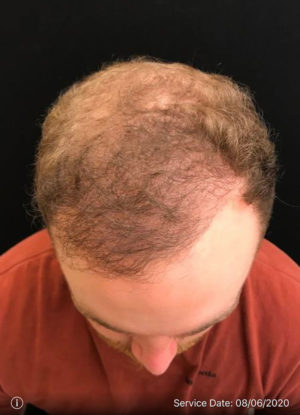 Neograft Hair transplantation