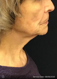 Nonsurgical Lift