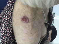 Squamous Cell Carcinoma