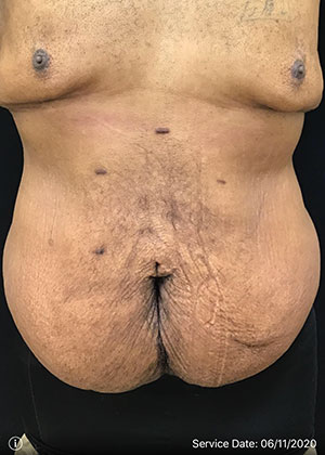 Abdominal Panniculectomy