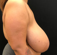 Breast Reduction
