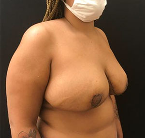 Breast Reduction