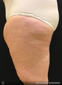 Liposuction