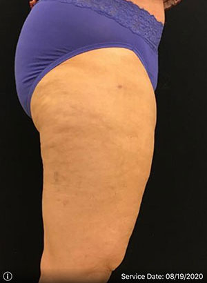 Liposuction