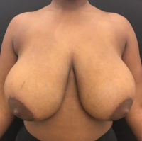 Breast Reduction