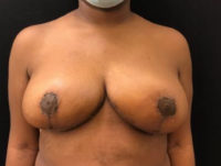 Breast Reduction