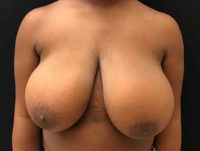 Breast Reduction