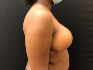 Breast Reduction