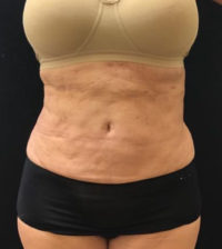 Liposuction