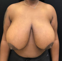 Breast Reduction